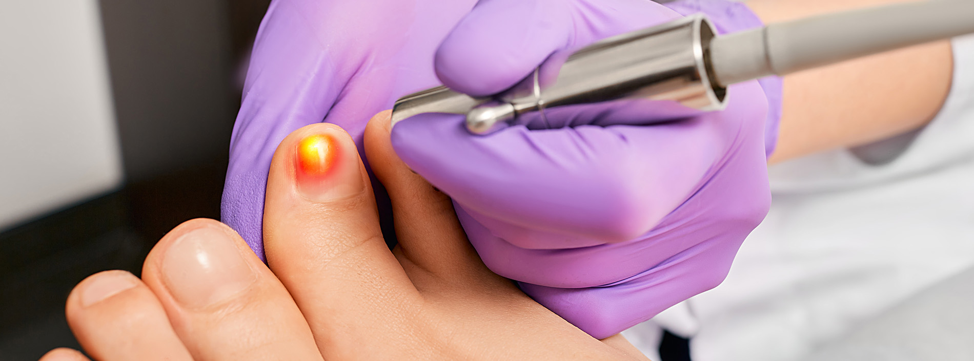 A healthcare professional applying a red nail polish to a patient s toe with a medical device.